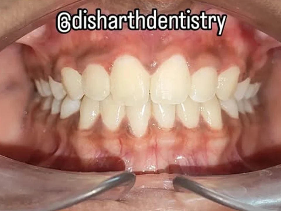 After smile restoration