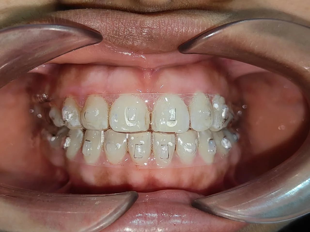 Real clear aligner treatment at Disharth Dentistry