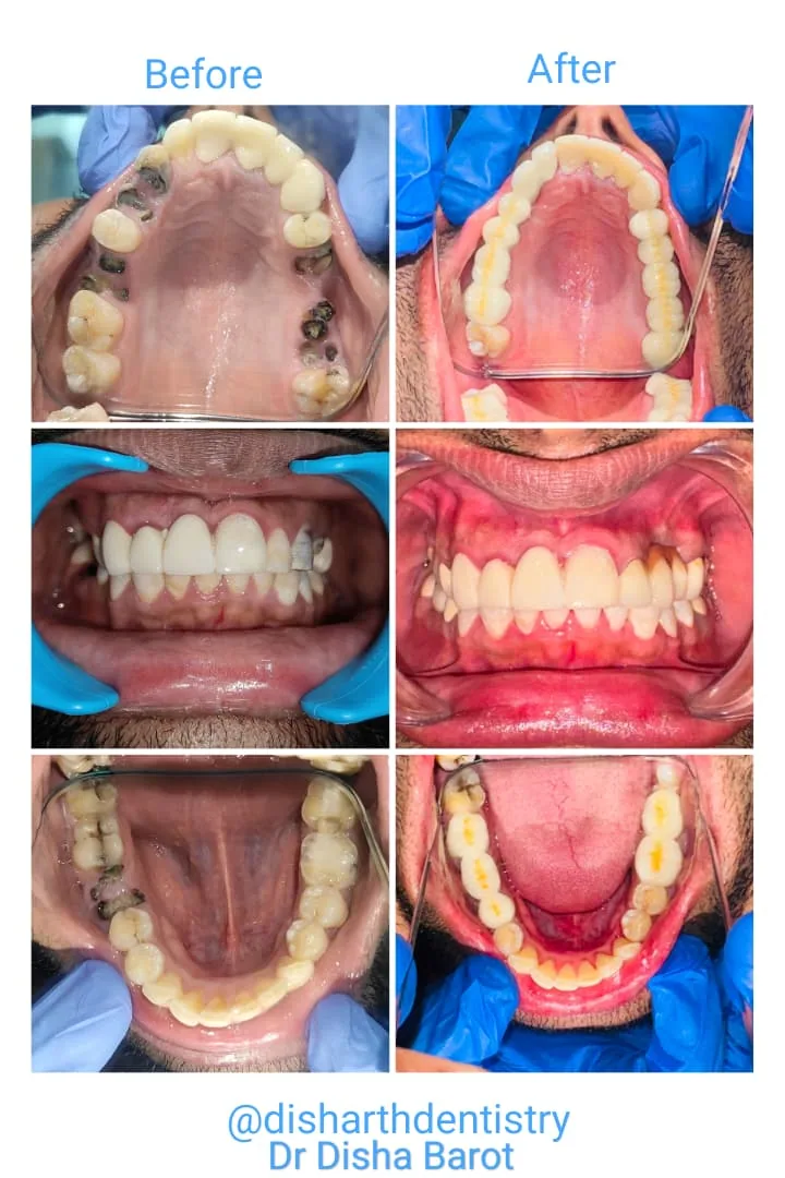 Real full mouth rehabilitation case