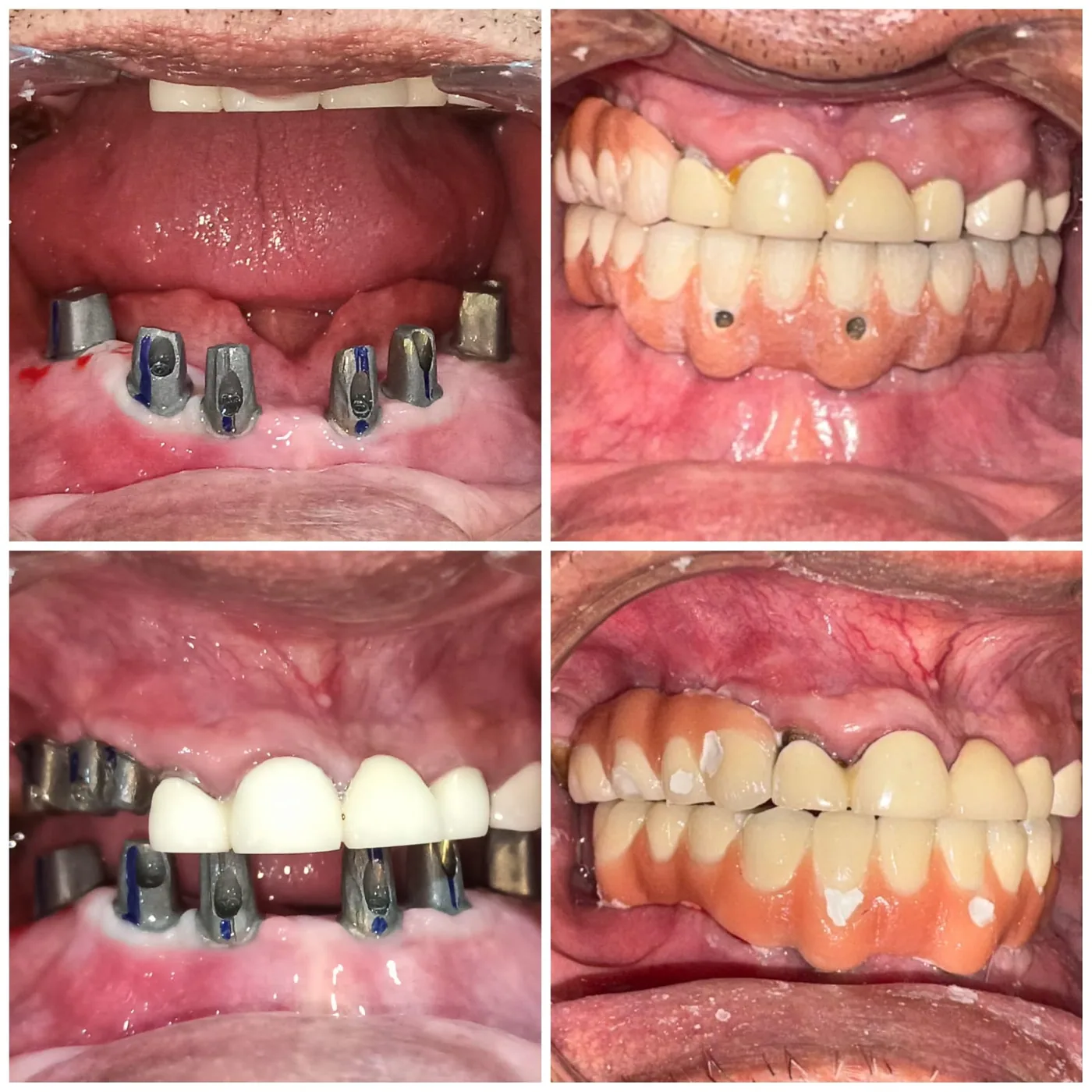 Real Disharth Dentistry dental implant full mouth case