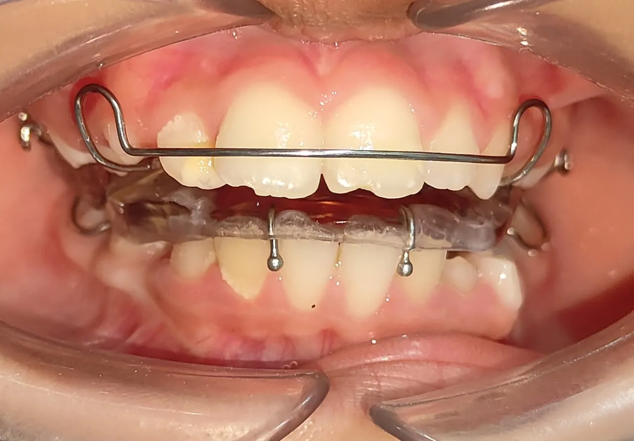 Real child orthodontic appliance treatment