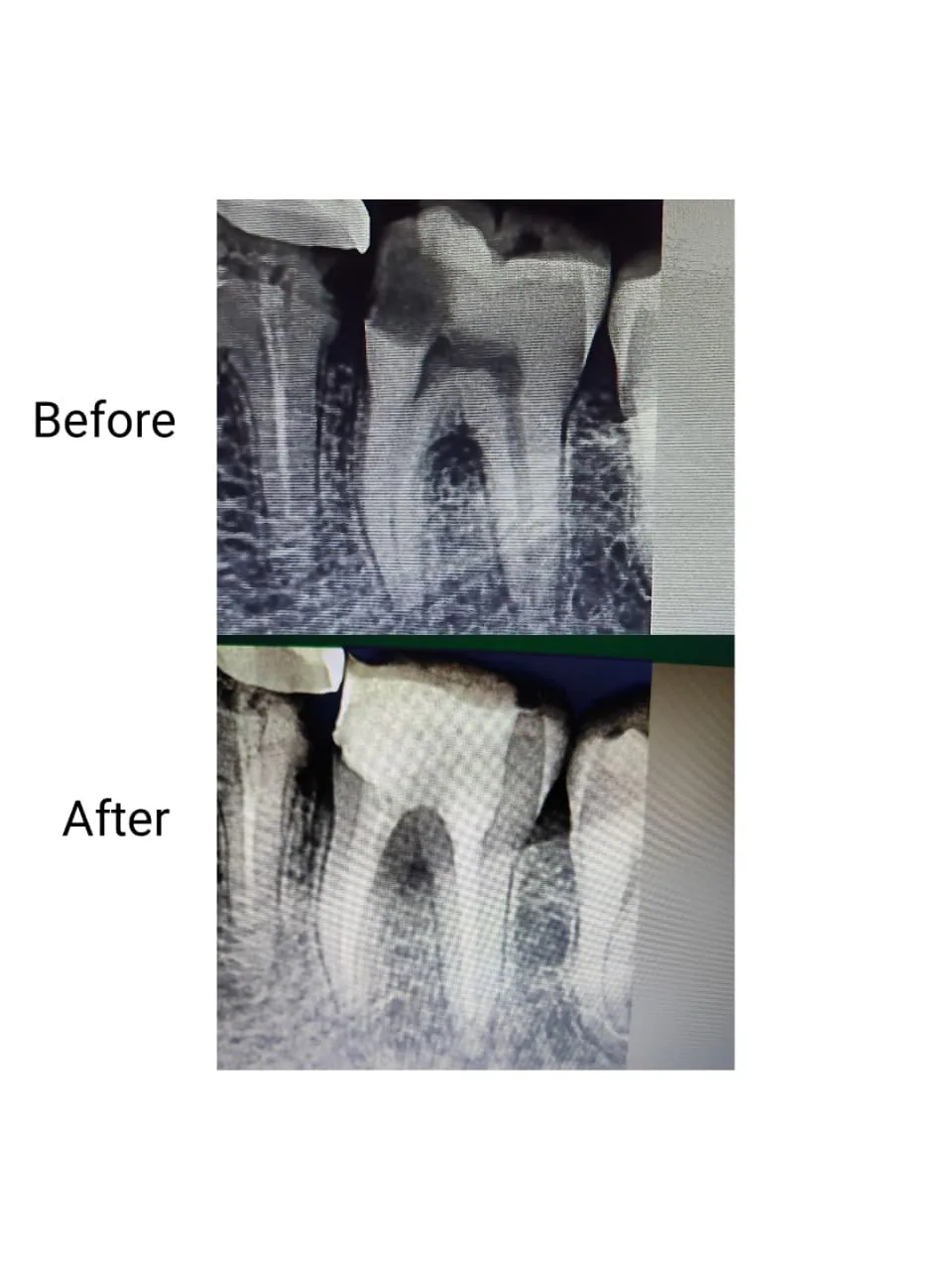 Real root canal X-ray before and after