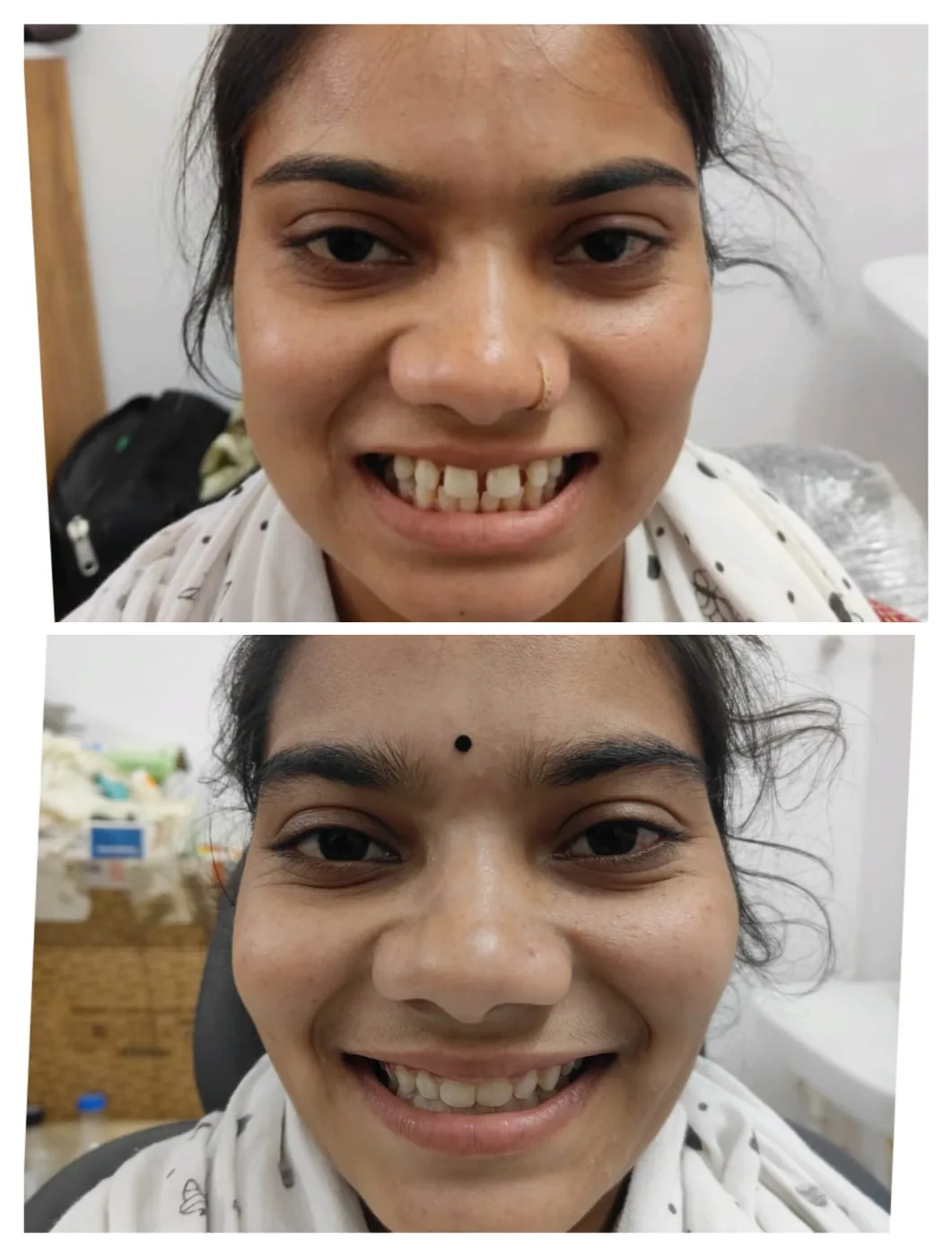 Before smile design treatment