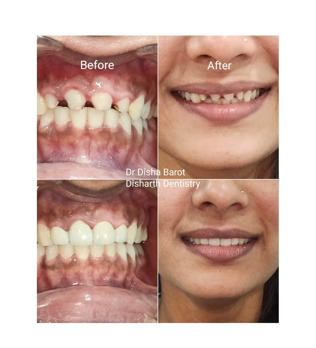Real smile design and veneer case