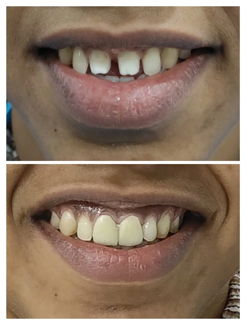 Real veneer smile restoration before and after at Disharth Dentistry