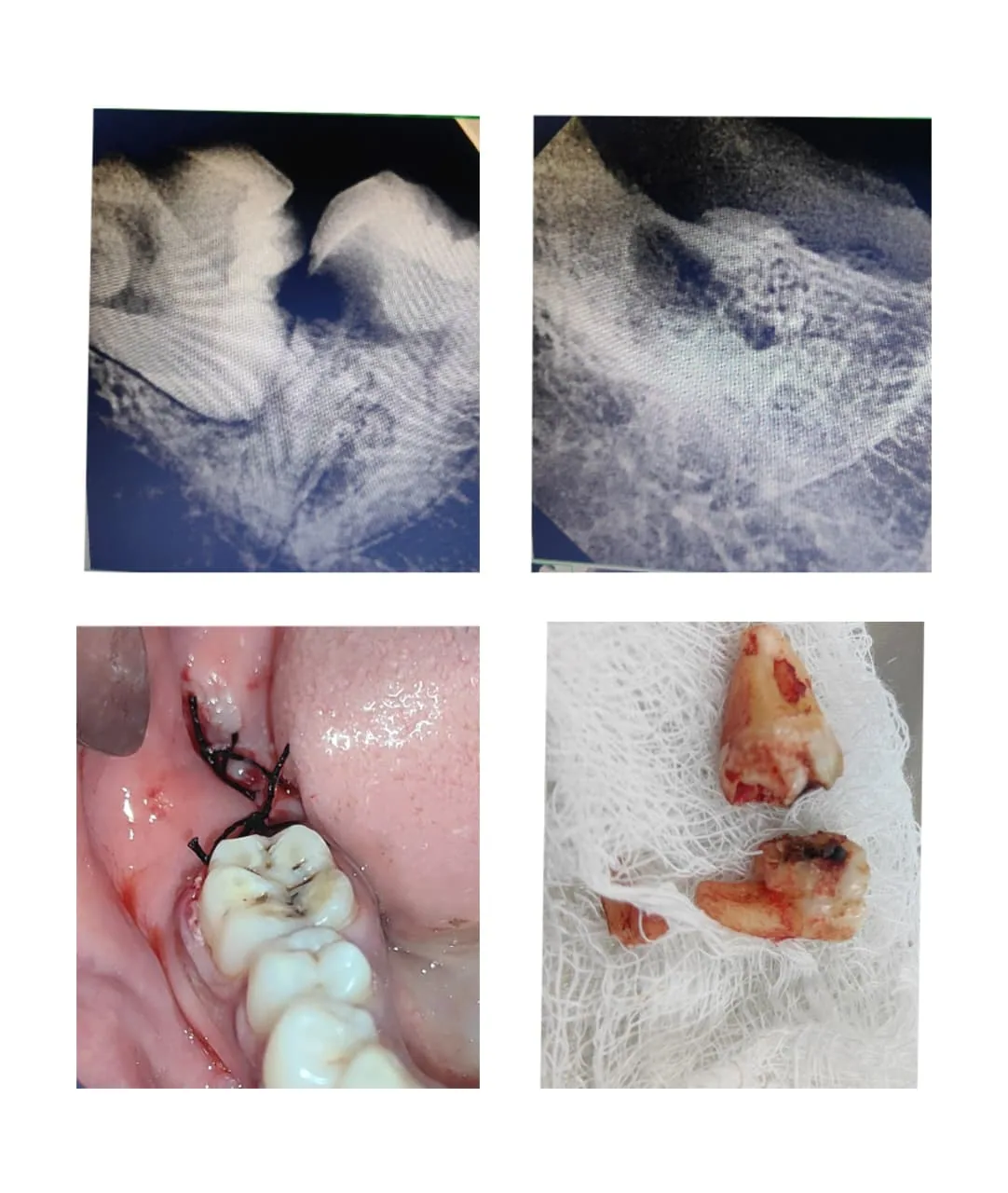 Real Disharth Dentistry wisdom tooth X-ray and surgical removal case